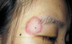 银屑病症状危害从哪里可以看得出来