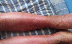 银屑病危害所需要产生的条件有哪些