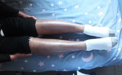 银屑病有什么危害