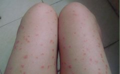 女性牛皮癣患者能喝豆浆吗？