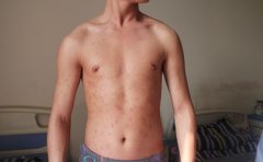 牛皮癣患者怎样调整可以睡眠质量呢