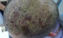 患上牛皮癣会有脱发现象吗-临沂如何治疗牛皮癣