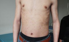 牛皮癣的遗传原因都有什么呢