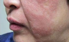 高温环境给牛皮癣患者带来的危害