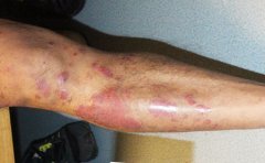 牛皮癣会给患者带来的危害