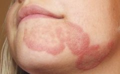 牛皮癣患者能不能抽烟？