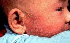 患有牛皮癣是否遗传