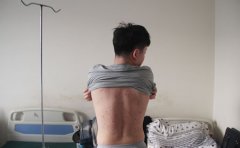 得了银屑病血液是否正常？