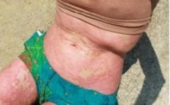 银屑病患者锻炼出汗能排毒吗