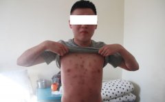 牛皮癣诊断是什么样的?