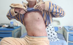 牛皮癣的诊断要点有哪些?