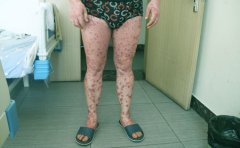 银屑病对患者身体造成哪些危害