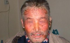 银屑病给老年人带来哪些危害