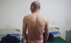 银屑病患者怎样正确的吃方便面