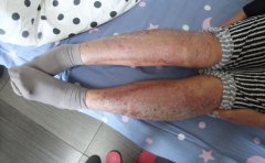 冬季牛皮癣可食用的食物