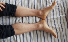 牛皮癣要注意饮食