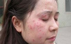 脸部牛皮癣怎样保养