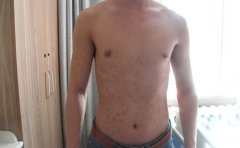 得了牛皮癣该怎样吃