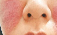 晨起一杯水有利牛皮癣病员身体健康