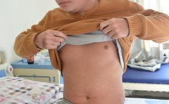 吃玉米会不会加重牛皮癣病患病情呢