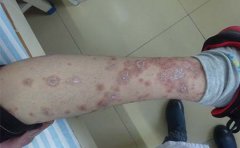 牛皮癣检查方法都有哪些需要注意的事项？