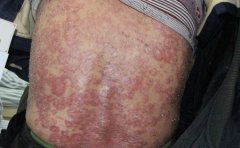 患有牛皮癣还可以吃巧克力吗