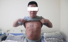 为什么牛羊肉牛皮癣患者不能吃？