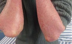 红皮型牛皮癣饮食禁忌