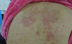 关节型银屑病发病率及诊断有哪些？