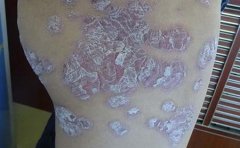 牛皮癣患者能吃哪些营养品