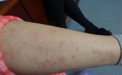 临沂牛皮癣解答饮食与疾病复发关系