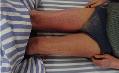 牛皮癣患者排毒可缓解病情