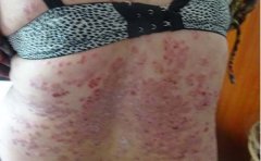 牛皮癣患者能不能喝点果汁