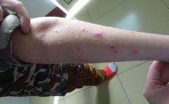 牛皮癣如何做到营养均衡呢？