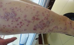 牛皮癣患者在夏季如何科学饮食？