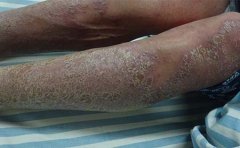 牛皮癣患者早晨喝豆浆有利