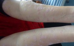 得了银屑病可以吃冬枣吗？