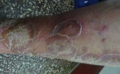 银屑病的饮食护理要注意啦