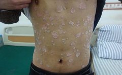 银屑病患者不宜吃的食物有哪一些？