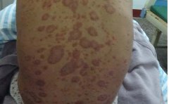 哪些瓜果多吃对银屑病有可以处