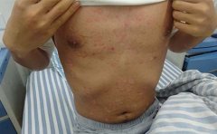 牛皮癣的人在吃饭上有很多要禁忌，能吃辣椒蒜吗？