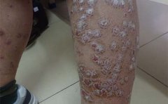 牛皮癣患者可以吃黄花菜吗