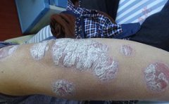 牛皮癣患者吃糖时需注重吗?