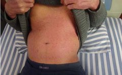 饮食可以治疗牛皮癣吗