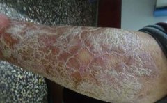 牛皮癣患者可不可以喝豆浆呢?