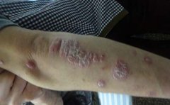 吃醋可以缓解牛皮癣病情吗