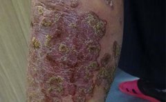 牛皮癣患者夏季养生要注意？