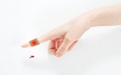 牛皮癣患者外伤会留下疤痕吗？临沂可以治牛皮癣的医院