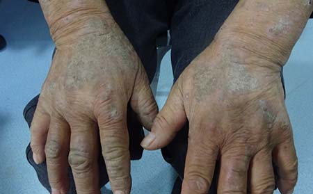 银屑病医院哪个治的好,关节型银屑病