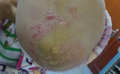 临沂得银屑病临床上的症状及预防